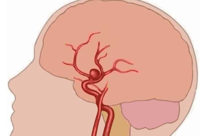 penyebab aneurisma otak